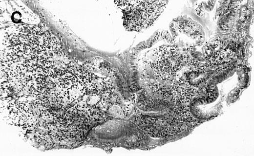 Fig. 1. (A) Case no. 1. (B and C) Case no. 2. (D) Case no. 3. (E) Case no. 4. (A, B, D, and E) Duodenal biopsies showing total villous atrophy with crypt hyperplasia and infiltration of lamina propria by nonatypical inflammatory cells (Hematoxylinandeosin; original magnification × 10). (C) Jejunal biopsy showing villous atrophy and ulcerations with regenerative epithelial changes on the border of ulcerations; no evidence of lymphoma.