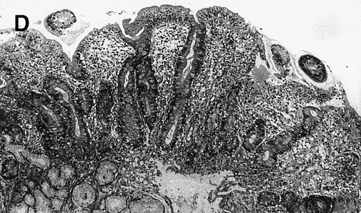 Fig. 1. (A) Case no. 1. (B and C) Case no. 2. (D) Case no. 3. (E) Case no. 4. (A, B, D, and E) Duodenal biopsies showing total villous atrophy with crypt hyperplasia and infiltration of lamina propria by nonatypical inflammatory cells (Hematoxylinandeosin; original magnification × 10). (C) Jejunal biopsy showing villous atrophy and ulcerations with regenerative epithelial changes on the border of ulcerations; no evidence of lymphoma.