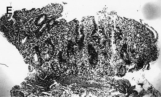 Fig. 1. (A) Case no. 1. (B and C) Case no. 2. (D) Case no. 3. (E) Case no. 4. (A, B, D, and E) Duodenal biopsies showing total villous atrophy with crypt hyperplasia and infiltration of lamina propria by nonatypical inflammatory cells (Hematoxylinandeosin; original magnification × 10). (C) Jejunal biopsy showing villous atrophy and ulcerations with regenerative epithelial changes on the border of ulcerations; no evidence of lymphoma.