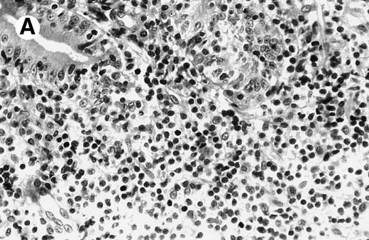 Fig. 2. Case no. 2, original magnification × 25. (A) Mononuclear infiltrate in duodenal lamina propria without cellular atypia. (B) Same magnification of liver biopsy 4 months later. Note complete destruction of liver parenchyma by atypical large cells signaling non-Hodgkin anaplastic lymphoma.