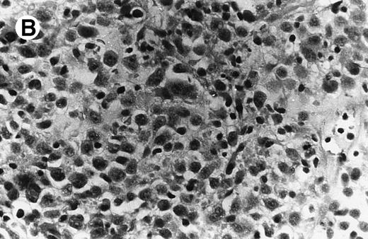 Fig. 2. Case no. 2, original magnification × 25. (A) Mononuclear infiltrate in duodenal lamina propria without cellular atypia. (B) Same magnification of liver biopsy 4 months later. Note complete destruction of liver parenchyma by atypical large cells signaling non-Hodgkin anaplastic lymphoma.