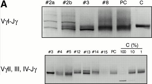 Fig. 3. PCR analysis of TCR Vγ-Jγ genes in duodenal biopsies of patients with complicated CD, untreated CD responsive to GFD, and dyspeptic controls. (A) Representative experiments using VγI-Jγ (top) and VγII, III, IV-Jγ (bottom) specific oligonucleotides. Sample numbers refer to patient numbers in Tables 1 and 2. Samples no. 2 and 3 demonstrate a clonal pattern. In patient no. 2, an identical VγI-Jγ biallelic rearrangement was found in (a) duodenal mucosa and in (b) jejunal mucosa 108 days later. In case no. 3, a monoallelic VγI-Jγ and a monoallelic VγII, III, IV-Jγ rearrangement were detected. PC, polyclonal control; C, clonal control. Dilution of the clonal control into peripheral blood lymphocytes polyclonal DNA (from 100% to 1%) has been included in the experiments and is shown for the VγII, III, IV-Jγ experiments. (B) Analysis of patient no. 4 DNAs. (Top) VγI-Jγ rearrangements. A clonal rearrangement was found in the 3 patients’ samples. (a) Duodenal biopsy at entry; (b) duodenal biopsy 30 days later; (c) peripheral blood specimen obtained 64 days later at the moment of overt lymphoma. PBL, peripheral blood lymphocytes from a polyclonal control. (C) Analysis of patient no. 3 DNAs by multiplex PCR. (a) Duodenal biopsy; (b through f) postmortem samples obtained 30 months later. (b) Small bowel; (c) colon; (d) thoracic lymph nodes; (e) mesenteric lymph nodes; (f) colonic mucosa. PC, polyclonal control; C, dilution of the clonal control into peripheral blood lymphocytes polyclonal DNA (from 100% to 1%).