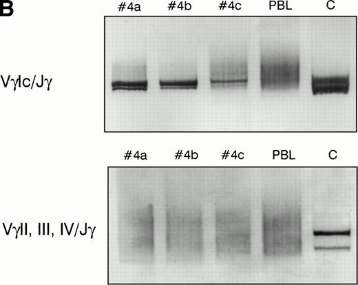 Fig. 3. PCR analysis of TCR Vγ-Jγ genes in duodenal biopsies of patients with complicated CD, untreated CD responsive to GFD, and dyspeptic controls. (A) Representative experiments using VγI-Jγ (top) and VγII, III, IV-Jγ (bottom) specific oligonucleotides. Sample numbers refer to patient numbers in Tables 1 and 2. Samples no. 2 and 3 demonstrate a clonal pattern. In patient no. 2, an identical VγI-Jγ biallelic rearrangement was found in (a) duodenal mucosa and in (b) jejunal mucosa 108 days later. In case no. 3, a monoallelic VγI-Jγ and a monoallelic VγII, III, IV-Jγ rearrangement were detected. PC, polyclonal control; C, clonal control. Dilution of the clonal control into peripheral blood lymphocytes polyclonal DNA (from 100% to 1%) has been included in the experiments and is shown for the VγII, III, IV-Jγ experiments. (B) Analysis of patient no. 4 DNAs. (Top) VγI-Jγ rearrangements. A clonal rearrangement was found in the 3 patients’ samples. (a) Duodenal biopsy at entry; (b) duodenal biopsy 30 days later; (c) peripheral blood specimen obtained 64 days later at the moment of overt lymphoma. PBL, peripheral blood lymphocytes from a polyclonal control. (C) Analysis of patient no. 3 DNAs by multiplex PCR. (a) Duodenal biopsy; (b through f) postmortem samples obtained 30 months later. (b) Small bowel; (c) colon; (d) thoracic lymph nodes; (e) mesenteric lymph nodes; (f) colonic mucosa. PC, polyclonal control; C, dilution of the clonal control into peripheral blood lymphocytes polyclonal DNA (from 100% to 1%).
