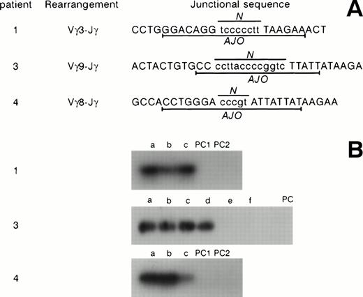 Fig. 4. Clones TcR γ junctional sequences in patients no. 1, 3, and 4. (A) The sequences, the Vγ segments involved, and the clone-specific antijunctional oligonucleotides (AJO) are shown. N, N regions. (B) Hybridization experiments using patient-specific AJO probes. (1) Patient no. 1; (a) jejunum; (b) accessory spleen; (c) mesenteric lymph nodes. (3) Patient no. 3; (a) duodenal biopsy; (b through f) postmortem samples obtained 30 months later. (b) Small bowel; (c) sigmoid colon; (d) colon; (e) thoracic lymph nodes; (f) mesenteric lymph nodes. (4) Patient no. 4; (a) duodenal biopsy; (b) jejunal biopsy 30 days later; (c) peripheral blood specimen obtained 64 days later at the time of overt lymphoma. PC, polyclonal controls.