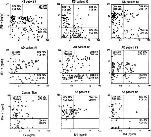 Fig. 1. Th2- and Tc2-skewed cytokine profile of CD4+ and CD8+ T-cell clones generated from the neoplastic skin of patients with KS. Clones were obtained from skin biopsy specimens, taken for diagnostic purpose from three HIV-infected patients with KS. As controls, cytokine production by T-cell clones generated under the same experimental conditions from skin biopsy specimens of one healthy volunteer, two patients with alopecia areata (AA), and three patients with atopic dermatitis (AD) was evaluated. Each symbol represents the amounts of IL-4 and IFN-γ produced by a single CD4+ (open squares) or CD8+ (closed circles) T-cell clone. Lines represent cutoff values (IFN-γ, 0.8 ng/mL; IL-4, 0.2 ng/mL), calculated as 5 SD over values found in cultures containing feeder cells alone.