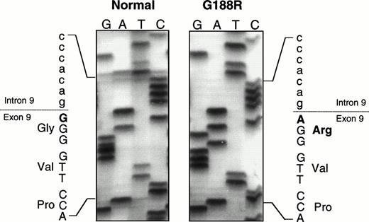Fig. 2. Partial sequencing gel showing the G188R missense mutation, a G to A transition at cDNA nt 562, the first base of exon 9, which predicts the substitution of an arginine for a glycine.