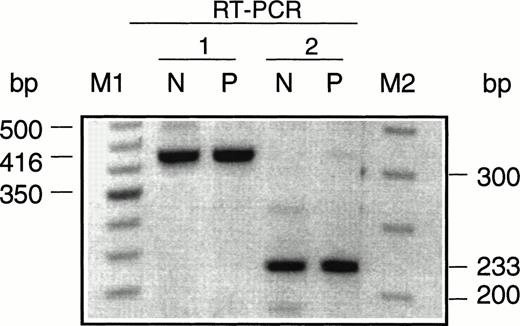 Fig. 3. Agarose gel electrophoresis of the URO-synthase RT-PCR products amplifed from total lymphoblast RNA from a normal individual (N) and the CEP patient (P). RT-PCR 1 used primers that amplified a normal 416-bp product from exon 6 to exon 10 and RT-PCR 2 used primers that amplified a 223-bp product from exon 8 to exon 10. Note that the RT-PCR products of the normal individual and the CEP patient were the same size.