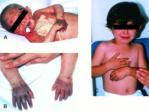 Fig. 1. (A and B) Patient before BMT, at 18 months old; (C) patient 27 months post-BMT, at 35 months old.