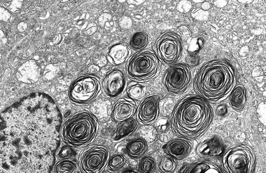 Alveolar cell carcinoma of the lung. A 52-year-old woman smoker with a history of breast carcinoma 6 years earlier was evaluated for a single lung nodule. Light microscopy showed a bronchiolo-alveolar growth pattern of an adenocarcinoma which did not resemble the earlier breast carcinoma in breast or axillary lymph nodes. Electron microscopy was diagnostic for alveolar cell carcinoma. The tumor cells formed glands and were filled with lamellar bodies, often referred to as surfactant bodies. These secretory granules are diagnostic for adenocarcinoma cells of type II alveolar pneumocyte origin in primary and metastatic tumor sites. Original magnification ×13,000. (Courtesy of Ann M. Dvorak, MD, Department of Pathology, Beth Israel Deaconess Medical Center, Harvard Medical School, Boston, MA.)