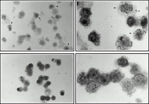 Fig. 5. 3H Thymidine labeling of 5-FU cells. Bone marrow cells selected in 5-FU, IL-3, and SCF were incubated for 48 hours on monolayers of retroviral producer cells and labeled for 24 hours in the presence of 3H thymidine. (Top panels) Cells incubated with producer line 1MI-▵SCF. (Bottom panels) Cells incubated with producer line 1MI and exogenous soluble SCF (100 ng/mL). (Left-hand panels) Photographed at 400× original magnification; (right-hand panels) 1,000× (oil immersion). Arrowheads indicate examples of labeled cells.