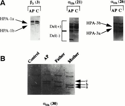 Fig. 1. PCR-SSCP analysis of the IIband β3 genes. PCR amplification products were submitted to SSCP analysis by electrophoresis on the minigels of the PhastSystem apparatus and the migrated products detected by silver staining. (A) Only the amplification product for exon 3 of the β3 gene of patient A.P. exhibited a different migration profile to the control (C); this corresponded to the HPA-1 genetic determinant, the control being HPA-1a/HPA-1a and the patient being HPA-1a/HPA-1b. For the IIb gene, three amplification products had different patterns when compared with the control. For amplification product 21, this corresponded to a previously described polymorphism (Noted Del+ and Del−) in intron 21. Amplification product 26 corresponded to the HPA-3 system, the control being HPA-3a/HPA-3a and the patient being HPA-3a/HPA-3b. (B) SSCP analysis of amplification product 30 of the IIbgene showed a previously undescribed pattern. Illustrated are the patterns obtained for the patient (A.P.), a control, his father, and his mother. Band a was present for the control and the two parents, band b for A.P. and his mother, and band c for A.P. and his father.
