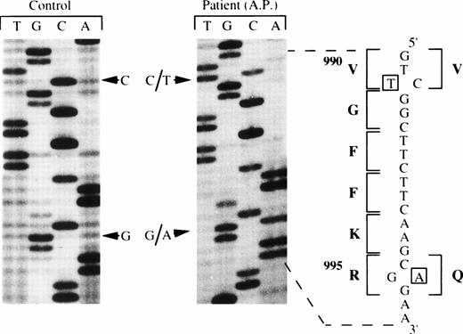 Fig. 2. Direct DNA sequencing of amplification product 30 of the IIb gene for the control and for the patient (A.P.). Two detected heterozygous mutations are indicated in open squares and the corresponding amino acid sequence and the substitution R995to Q are noted with bold letters.