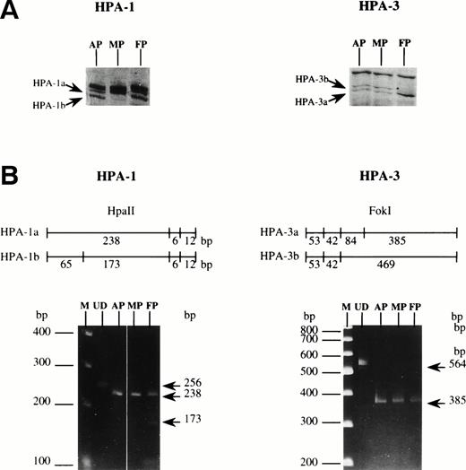 Fig. 6. HPA-1 and HPA-3 typing on DNA and on mRNA from platelets from patient A.P., his mother (M.P.), and his father (F.P.). (A) SSCP analysis was performed on genomic DNA fragments. (B) Amplified cDNA was subjected to restriction enzyme digestion, HpaII for HPA-1 andFokI for HPA-3. The predicted size of the products is indicated. Analysis was performed on 10% polyacrylamide gels stained using EtBr (see arrows). M, size markers; UD, undigested fragment.