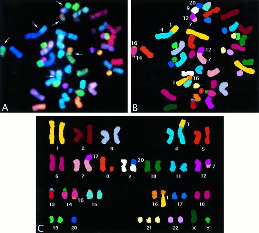 Fig. 1. Spectral karyotyping of bone marrow chromosomes. Demonstration of simultaneous hybridization of 24 combinatorially labeled chromosome painting probes shown in display colors, aberrant chromosomes are highlighted by arrows (A). Spectra-based classification of the display colors shown in the same metaphase chromosomes, numbers beside chromosomes denote origin of translocated material (B). Karyotype of classification-colored chromosomes (C).