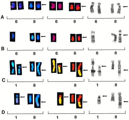 Fig. 3. Partial karyotypes from four different patients showing recurring translocations t(6;8)(p10;q10) and t(1;8)(p11;q24). Each row represents a different patient sample, with brackets within each row indicating a different representation of the same reciprocal translocation. Chromosomes are presented in SKY display colors (left brackets), SKY classification colors (center brackets), and G-banding (right brackets). Patient samples no. 33 and 39 show whole-arm translocation t(6;8)(p10;q10) (A and B). Patient samples no. 7 and 28 show reciprocal translocation t(1;8)(p11;q24) (C and D).