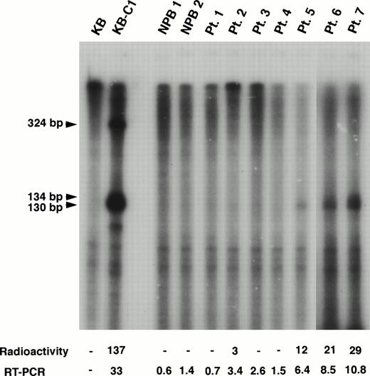 Fig. 3. RNase protection assay of normal PB cells and AML patients. In this experiment, the MDR1 antisense probe was used. The KB cells were used as a negative control and the multidrug resistant KB-C1 cells were used as a positive control. The sizes of protected products were indicated by arrows. Radioactivity corresponding to the 130/134-bp bands and mRNA levels obtained by quantitative RT-PCR analysis are presented below the panel.