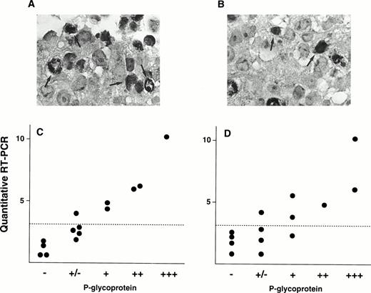Fig. 5. Immunohistochemical staining of P-gp (A and B) and correlation of P-gp levels and MDR1 mRNA levels in AML patients (C and D). Examples of immunostaining using anti-P-gp antibody Ab-1 are shown in (A) and (B). A large portion of cancer cells were stained for P-gp in Pt. 7 (A) and a small portion of cancer cells in Pt. 2 (B) (original magnification × 400). Some of cells positively immunostained for P-gp were indicated by arrows. Immunohistochemical analysis was performed on many other patients with both anti–P-gp antibody Ab-1 (C) and MRK-16 (D). Correlations between P-gp levels by immunohistochemical analysis and MDR1 mRNA levels by RT-PCR are shown in (C) and (D). Dashed line indicates cut-off point ofMDR1 mRNA expression.