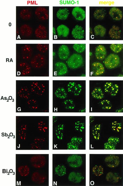 Fig. 3. Trivalent antimonials trigger the reorganization of PML NBs in APL Cells. NB4 cells were subjected to double-immunofluorescence staining with a polyclonal anti-PML antibody and a monoclonal anti–SUMO-1 antibody. Labeling was performed on untreated cells (A through C), cells treated for 36 hours with 1 μmol/L RA (D through F), or cells treated for 10 hours with either 1 μmol/L As2O3 (G through I), 1 μmol/L Sb2O3 (J through L), or 1 μmol/L Bi2O3 (M through O). The staining pattern was analyzed by confocal laser microscopy. The red signal (PML) is obtained with an anti-rabbit Ig Texas red–conjugated secondary antibody, the green signal (SUMO-1) with an anti-mouse Ig fluorescein–conjugated secondary antibody. Superimposing of the two colors (merge) results in a yellow signal, where both proteins colocalize.