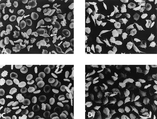 Fig. 5. Scanning electron microscopy of RBCs from a high S-Oman patient. (A) Oxygenated; (B) deoxygenated. Notice the yarn/knitting needle shape of the irreversibly sickled cells characteristic of this disease, highlighted by white arrows. Notice that after full deoxygenation almost all of the cells sickled with long, thin protuberances. The lower two panels (C) and (D) are of a low S-Oman patient. (C) Oxygenated, looks quite normal except for a few echinocytic and otherwise deformed RBCs. No yarn/knitting needle cells. (D) Fully deoxygenated cells; again, almost all of the cells sickle, but with less elongated and numerous protuberances.