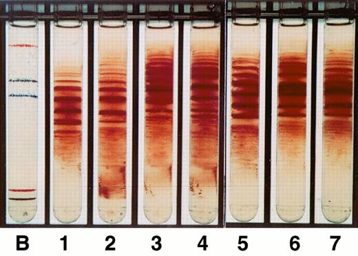 Fig. 2. Percoll-Larex gradients of the five members of the pedigree. Lane B, density beads; lane 1, normal blood; lane 2, sickle cell anemia; lane 3, HSR (high HbS-Oman); lane 4, ISH (high HbS-Oman); lane 5 MSR (high HbS-Oman); lane 6 MSK (low HbS-Oman); lane 7 SSR (low HbS-Oman).
