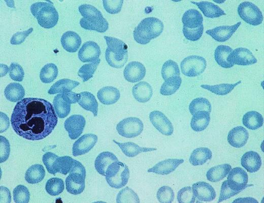 Fig. 4. Hematoxyline-eosine stained smear of a patient with high S-Oman expression. The characteristic shapes that resemble a ball of yarn transversed by knitting needles of the irreversibly sickled cells found in these patients is clearly visible. Also visible are target cells and other deformed cells, including folded cells.