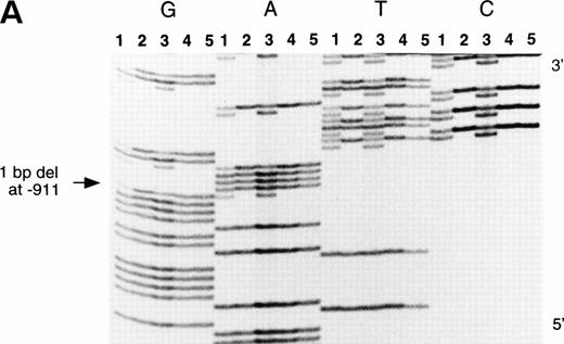 Fig. 3. DNA sequence immediately 5′ of the β-globin gene in the Greek Cypriot family. The individuals II1, I1, I2, II2, and II3 (as shown in Fig 2) are represented by lanes 1, 2, 3, 4, and 5. The termination reactions are loaded in consecutive lanes in a block, ddGTP (G), ddATP (A), ddTTP (T), and ddCTP (C). (Panel A) The 5′ breakpoint indicated by the 1-bp deletion (arrowed) at position −911; (Panel B) the 3′ breakpoint indicated by the arrow (Rsa I site) at position −550.