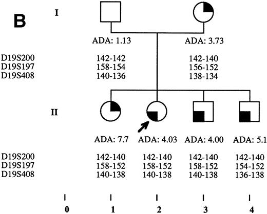 Fig. 2. Pedigrees of families simultaneously showing DBA and isolated high eADA phenotype. (A) Recombination events occurred on meiosis from individuals III-3 and II-5. Allele sizes for microsatellite D19S200 could not be determined for individuals II-13 and III-13, and they were therefore not included in the haplotype analysis. (B) Unlike the three DBA cases of this family, individual II-1 was previously diagnosed as transient erythroblastopenia, and her mother (I-3) was healthy. (C) DBA index case of this family (patient IV-6) responded to interleukin-3 and is still independent of transfusions and steroids on the long-term follow-up. (D) All three siblings showed high eADA levels (II-1, -2, -3) and have normal blood count and hemoglobin electrophoresis, without known history of anemia. (E) Individuals I-2 and II-3 show classical DBA phenotype. eADA of individual II-2 was found increased at birth and remains over normal limits without any episode of anemia, and no other biological abnormality. eADA measurements of individuals I-1 and I-3 were performed in another laboratory, and results are within normal values for the technique considered. (F) Individual II-3 does not share the same haplotype as the DBA index case of the family. NA, not available.