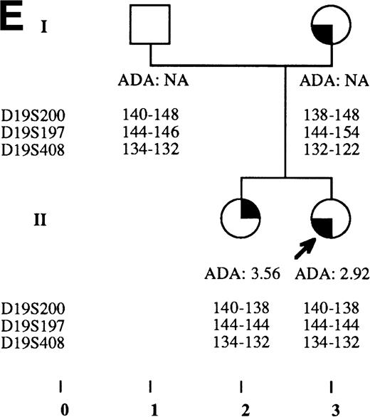Fig. 2. Pedigrees of families simultaneously showing DBA and isolated high eADA phenotype. (A) Recombination events occurred on meiosis from individuals III-3 and II-5. Allele sizes for microsatellite D19S200 could not be determined for individuals II-13 and III-13, and they were therefore not included in the haplotype analysis. (B) Unlike the three DBA cases of this family, individual II-1 was previously diagnosed as transient erythroblastopenia, and her mother (I-3) was healthy. (C) DBA index case of this family (patient IV-6) responded to interleukin-3 and is still independent of transfusions and steroids on the long-term follow-up. (D) All three siblings showed high eADA levels (II-1, -2, -3) and have normal blood count and hemoglobin electrophoresis, without known history of anemia. (E) Individuals I-2 and II-3 show classical DBA phenotype. eADA of individual II-2 was found increased at birth and remains over normal limits without any episode of anemia, and no other biological abnormality. eADA measurements of individuals I-1 and I-3 were performed in another laboratory, and results are within normal values for the technique considered. (F) Individual II-3 does not share the same haplotype as the DBA index case of the family. NA, not available.
