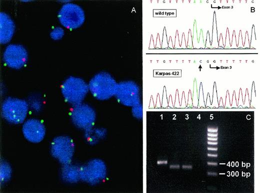 Fig. 1. (A) FISH with YAC 746H8 (red fluorescence) containing the PTEN/MMAC1 gene and YAC 790H10 (green fluorescence) containing the MXI1 gene on the cell line Karpas 422. The interphase nuclei display two green signals indicating the two copies of the MXI1 gene but only one red signal indicating loss of one PTEN/MMAC1 allele. Some signals are out of focus. (B) Genomic sequencing exon 3 of PTEN/MMAC1 in a control (top) and Karpas 422 (bottom) revealing a splice acceptor site mutation (A → C) at position −2. (C) RT-PCR analysis of a control (lane 1) and Karpas 422 (lanes 2 and 3) with primers surrounding exon 311 showing a lack of the expected germline 397-bp fragment but a 45-bp shorter PCR product caused by skipping of exon 3. Lane 4, H2O-control. Lane 5, 100-bp ladder.