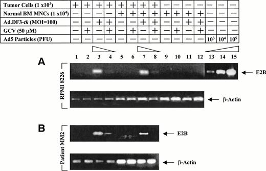 Fig. 6. Detection of Ad5 E2B adenoviral DNA in RPMI 8226 MM cells, patient MM2 cells, and normal BM MNCS transduced with Ad.DF3-tk and then treated with GCV. RPMI 8226 MM cells (A) or patient MM2 cells (B; 1 × 103/sample; lanes 1 through 4); RPMI 8226 MM cells (A) or patient MM2 cells (B; 1 × 103/sample) mixed with normal BM MNCs (1 × 104/sample; lanes 5 through 8); or normal BM MNCs (1 × 104/sample; lanes 9 through 12) were either nontransduced (lanes 1, 2, 5, 6, 9, and 10) or transduced with Ad.DF3-tk (MOI = 100; lanes 3, 4, 7, 8, 11, and 12) for 2 hours and then washed out for 10 hours. Cells were next cultured with GCV (50 μmol/L; lanes 2, 4, 6, 8, 10, and 12) or without GCV (lanes 1, 3, 5, 7, 9, and 11) for 36 hours. The E2B gene was amplified by PCR, as previously reported,1728 from viral DNA extracted following cell lysis. Viral DNA obtained from Ad.DF3-tk particles (1 × 103 to 1 × 105 PFU) served as a positive control (lanes 13 through 15). PCR for β-actin confirmed integrity of DNA.
