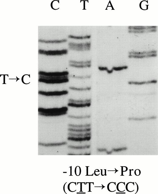 Fig. 1. AT signal peptide mutation. Exon 2 PCR product was directly sequenced in the proband and a heterozygous single nucleotide substitution was identified at nucleotide 2418, leading to the amino acid substitution L(-10)P.