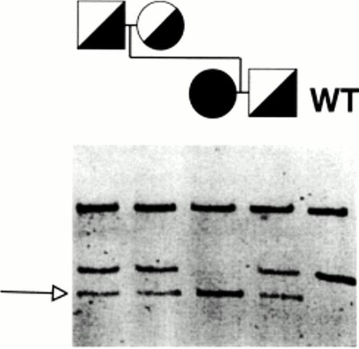 Fig. 2. SSCP analysis of exon 11 of GPIIIa amplified from genomic DNA. Genomic DNA fragment of 198 bp comprising exon 11 of GPIIIa and intronic flanking regions was amplified as described in Materials and Methods. The PCR products were digested with HinfI to yield fragments of 140 and 58 bp and electrophoresed in nondenaturing 16% acrylamide slab gels containing 8.7% glycerol. The arrow points to a distinct band shown by the patient, her parents, and her brother that is absent in the control (wt) DNA.