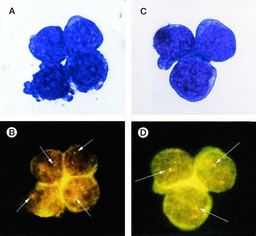 Fig. 5. A representative image of FISH applied to CD34+Thy-1+ and CD34+7+ cells sorted from BM. (A and C) May-Giemsa stain of CD34+Thy-1+ and CD34+7+ cells. (B and D) The hybridized bcr probe was detected with rhodamine (red signal) and the hybridized abl probe with fluorescein (yellow-green signal). A yellow or red/green spot was indicative of BCR/ABL fusion (white arrows).