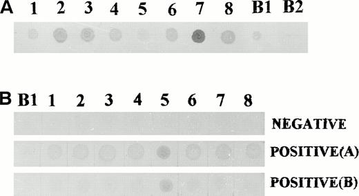Fig. 6. Dot blot analysis using crude fusion protein extracts. (A) Bacterial extracts from all eight clones contained fusion proteins capable of binding to anti–β-galactosidase antibodies. (B) Dot blot screening of sera for antibodies to leukemia derived proteins. (Top) Negative reactivity to all eight proteins. (Middle) Positive reactivity to all eight proteins. (Bottom) Positive reactivity to proteins derived from clone no. 5 only. B1, bacterial extract from a clone of blue phage; B2, bacterial extract from a nontransformed E coli.