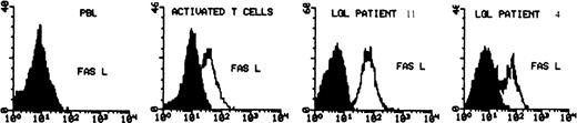 Fig. 2. Determination of CD95L expression on normal PBMC (before and after PHA/IL-2 activation) and in 2 cases of freshly isolated LGL leukemia (cases no. 4 and 11). The cells were fixed and permeabilized and then stained with anti-CD95L MoAb (C-20) followed by secondary antirabbit-FITC MoAb. The shaded area represents the level of fluorescence obtained with an isotype control MoAb, the unshaded area represents the level with CD95L MoAb.