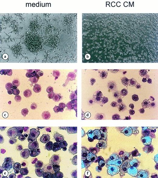 Fig. 3. Modulation of cell morphology by RCC medium. Cells cultured from day 6 to day 12 in GM-CSF+TNF alone (a, c, and e) or in the presence of 10% RCC CM (b, d, and f). Cell morphology as evaluated by phase contrast microscopy (a and b) and MGG staining (c and d) and phagocytic capacity (e and f) evaluated by FITC-coupled 0.5 μmol/L latex beads ingestion for the last 4 hours of culture time (counterstained with MGG). Results are representative of 10 different experiments.