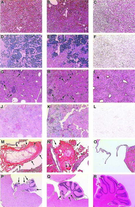 Fig. 3. Histological sections of kidney, liver, heart, and brain from sph/sph,sph/sph→+/+a, and +/+→+/+a mice. (A, D, G, J, M, and P) WBB6F1-sph/sph. (B, E, H, K, N, and Q)sph/sph→+/+a. (C, F, I, L, O, and R) +/+→+/+a. (A through C) Kidney sections stained with H&E. (D through F) Identical kidney sections as in (A) through (C) stained with Gomori’s iron stain, which stains nonhemoglobin iron blue (D and E). (G through I) Liver sections stained with H&E. Clusters of extramedullary hematopoiesis (arrows) stain purple (G and H). (J through L) Identical regions of liver as shown in (G) through (I) stained with Gomori’s iron stain. (M through O) Heart sections stained with H&E showing the large atrioventricular valve. Note the presence of thrombi (indicated by arrows) in the valves of (M) and (N), whereas the valve of (O) is unobstructed. (P through R) Sagittal brain sections stained with H&E showing the cerebellar region of the brain. Note the degeneration (arrows) of portions of the cerebellum in both (P), in which about one third of the cerebellum is missing due to infarction, and (Q), in which an interior portion of the cerebellum is infarcted. Note also the lack of degeneration in (R).