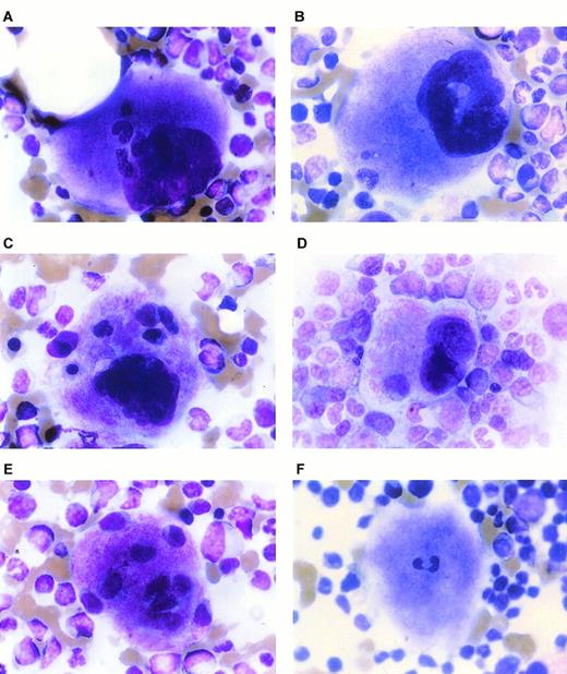 Megahemopseudophagocytosis. A 78-year-old man with myelodysplasia (MDS) of the refractory anemia (RA) subtype evolved to chronic myelomonocytic leukemia (CMML) over several years. Unexpectedly, his bone marrow demonstrated 17% plasma cells and further evaluation was consistent with an underlying plasma cell dyscrasia (PCD). It is noteworthy that his bone marrow also showed a marked increase in megakaryocytes (A through D) and megakaryocytic fragments (E and F), many of which (48%) displayed engulfment of erythroblasts (A through C), PMNs (A, B, and F), and/or lymphocytes (A and C through E), up to 10 per cell. “Phagocytosis” of blood elements (red blood cells, crythroblasts, lymphocytes, and myeloid cells) by megakaryocytes has only been discussed sporadically in the literature and was termed emperipolesis (wandering of one cell into another) in 1956 (Humbel et al, Br J Haematol 2:283, 1956). Because neither cell is damaged, this phenomenon does not represent true phagocytosis. It has been described in leukemias, MDS, myeloproliferative disorders, reactive thrombocytosis, malignancies, HIV, and ITP (Rozman et al,Br J Haematol 48:510, 1981). The mechanism and significance is unclear, and various theories concerning cytokines, adhesion molecules, increased cell traffic across the marrow-blood barrier, megakaryocytic cytoplasmic protection against a hostile bone marrow environment, and response to injured or altered megakaryocytes has been postulated (de Pasquale et al, Br J Haematol 60:384, 1985). Our case exemplifies this unusual phenomenon and is possibly attributed to his MDS/and or PCD. Our patient’s megakaryocytes appear to be more extensively involved than what has been previously described in the literature (48% v 30%) and include the internalization of all cell types, which also seems to be somewhat atypical. A more descriptive and memorable term for this entity might be megahemopseudophagocytosis. (Courtesy of Nancy J. Freeman, MD, and Angelina C. Carvalho, MD, Brown University School of Medicine, Oncology Section, Department of Veterans Affairs Medical Center, 830 Chalkstone Ave, Providence, RI 02908-4799.)