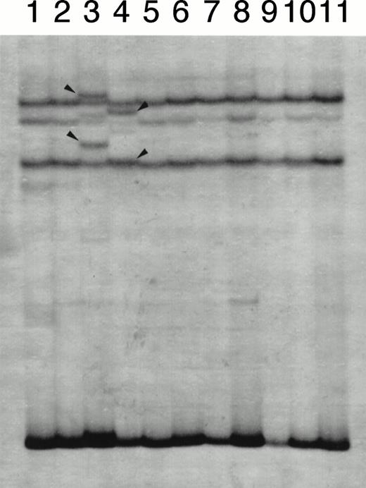 Fig. 2. A representative result of SSCP analysis of E2E4 segments. In addition to bands with normal mobility, bands with altered mobility were detected in lanes 3 (case no. 1) and 4 (case no. 2), which were marked with arrow heads.