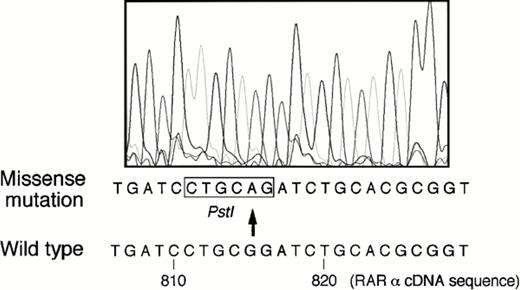 Fig. 4. DNA sequence of a subcloned E2E4 segment derived from case no. 1 who acquired ATRA resistance at relapse. The presence of G815A missense mutation was detected as compared with that of normal RARα/E-domain sequence. The position number of nucleotides was noted according to the sequence of normal RARα cDNA.