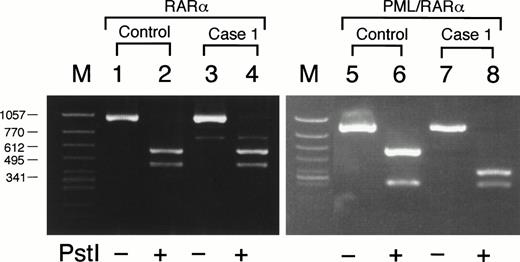 Fig. 5. Detection of G815A mutation by Pst I digestion in case no. 1. DNA segments amplified differentially from RARα in lanes 1 through 4 or from PML/RARα chimeric gene in lanes 5 through 8. Lanes 1 and 3, HL-60; lanes 5 and 7, an ATRA-sensitive control patient harboring a short PML/RARα isoform; lanes 2, 4, 6, and 8, case no. 1. PCR products in lanes 2, 4, 6, and 8 were digested with Pst I before electrophoresis. The Pst I digestion pattern of RARα-derived segments in case no. 1 (lanes 3 and 4) was similar to that of HL-60 (lanes 1 and 2). By contrast, the 873-bp segment derived from PML/RARα in case no. 1 was digested with Pst I into three fragments due to two Pst I sites including one additional site (lanes 7 and 8), which was not detected in a control patient without mutation (lanes 5 and 6).