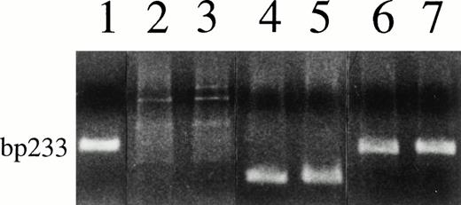 Fig. 1. Negative PCR test results for KSHV/HHV-8 on cell DNA from 2 myeloma patients (lanes 2 and 3) and a clear KSHV/HHV-8 band in BCBL cells (lane 1); positive PCR for β-globin of the patients' cell DNA (lanes 4 and 5); and no effects on viral amplification of patients' DNA mixed with BCBL cell DNA (lanes 6 and 7).