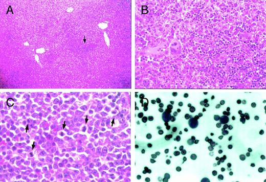 Fig. 7. Histological examination of the liver, spleen, and peripheral blood from heterozygous mutant female mice. Proerythroblasts and megakaryocytes accumulate in the sinus of the liver inGATA-1.05 mutant females (arrow in A). (B) is a higher magnification of (A) that contains the region pointed to by the arrow. Original magnifications × 10 (A) and × 80 (B). Mitotic figures were frequently seen in accumulated proerythroblasts in the spleen (arrows in C; original magnification × 200). Proerythroblasts were also observed in the peripheral blood of heterozygous mutant female mice with severe anemia and marked splenomegaly (D; original magnification × 200). The sections (A) through (C) were stained with hematoxylin and eosin reagent, whereas the blood smear was stained with Wright-Giemsa reagent (D).