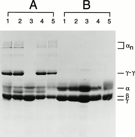 Fig. 1. Fibrin cross-linking in plasma clots of family members where the Asn344 deletion was identified. (A) Fibrin clots in the reaction containing CaCl2 and thrombin (test). (B) Fibrin clots in the reaction containing EDTA and thrombin (control). In each panel: lane 1, maternal sample; lane 2, paternal sample; lane 3, patient's sample; lane 4, brother's sample; and lane 5, a normal control sample. The symbols α, β, γ represent uncross-linked fibrin chains, αn represents α chain polymers, and γ-γ represents γ chain dimers.