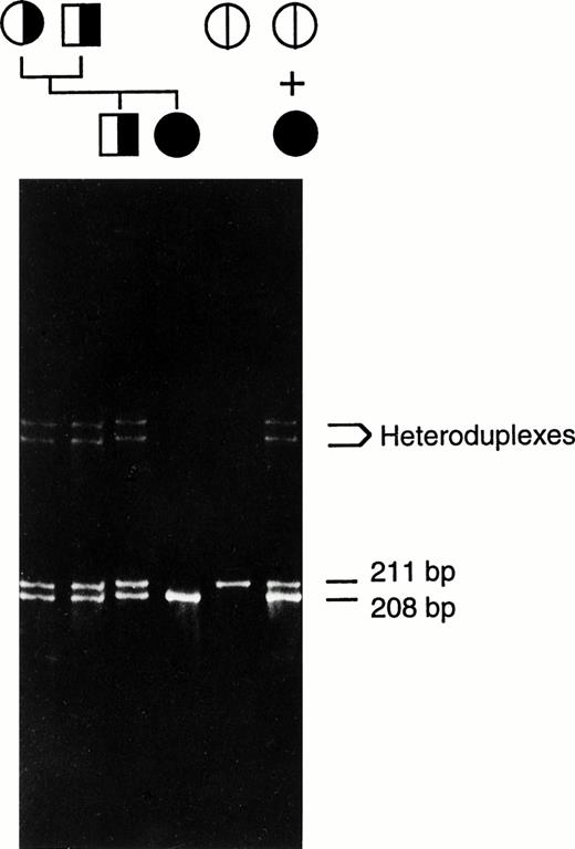 Fig. 2. Heteroduplex analysis of amplified exon 8 DNA. The mixture of the patient's and a normal subject's amplified DNA was run on the first lane on the right. Amplified normal exon 8 DNA was run as a control (second from right). The unmixed amplified DNA from the patient, her immediate family members, and normal control were also run on the same gel as indicated by the pedigree. The position of heteroduplexes (between normal and 3-bp deleted strands) and the length of homoduplexes (both normal and mutant alleles) are indicated. The genetic transmission of the 3-bp deletion is shown. The symbols for male (□) and female (○) are hatched according to the alleles present.