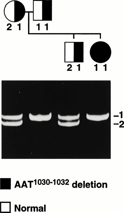 Fig. 4. The cosegregation of the 3-bp deletion (AAT1030-1032) in the A-subunit gene and the (AAAG)n STR alleles in the Thai family. The photograph shows the electrophoretic separation of the (AAAG)n PCR products from each family member. Repeat alleles have been numbered 1 and 2 exclusively in this family and do not relate to the number of repeats. The symbols for male (□) and female (○) are hatched according to the mutation alleles present.