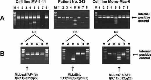 Fig. 1. Multiplex RT-PCR and split-out analysis. (A) The two cell lines MV-4-11 and Mono-Mac-6 and patient no. 243 were positive for a translocation in multiplex reaction R5 (see Table 3). (B) To determine the translocation, a split-out PCR analysis was performed using the individual primer sets R5A, R5B, R5C, and R5D. M, DNA molecular weight marker VI (Boehringer).