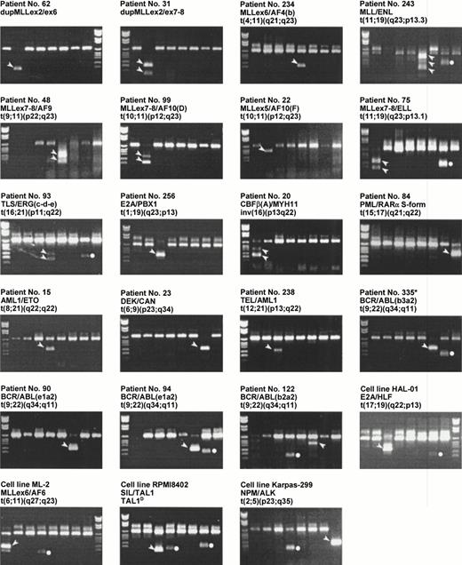Fig. 2. Examples on chromosomal aberrations found by the multiplex RT-PCR. The loading order and DNA molecular weight marker are as in Fig 1. The band specific for the translocation is indicated by an arrowhead beside the band. The dots indicate activation of HOX11 (lane 4) or EVI1 (lane 7). Because HOX11 and EVI1 represent activation of native gene products and not of chimerical products, these are not further discussed in this presentation. *Patient no. 335 was a chronic myeloid leukemia case not included in this study.