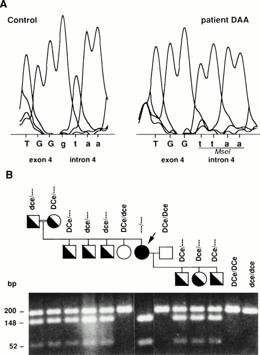 Fig. 2. Mutation of the RHCE gene in DAA and its inheritance in the family. (A) The g nucleotide of the 5′ donor splice-site of intron 4 from the normal RHCE gene in the RhD-negative control is replaced by a t in DAA. The Mse I site created by this mutation is shown. Intronic sequences are in lowercase. (B) Tree of family DAA and Mse I restriction pattern of the genomic PCR product encompassing the exon 4-intron 4 junction are shown. The “silent” RH chromosome segregating in the family is indicated by “- - -”. Solid symbols refer to homozygous (DAA propositus, arrow) or heterozygous individuals for the silent RH gene. Open symbols refer to wild-type RH genes. The 200-bp amplification product is digested with Mse I and is cleaved into two fragments of 148 and 52 bp in the mutated gene. PCR products from RhD-positive (DCe/DCe) and RhD-negative (dce/dce) controls were uncleaved.