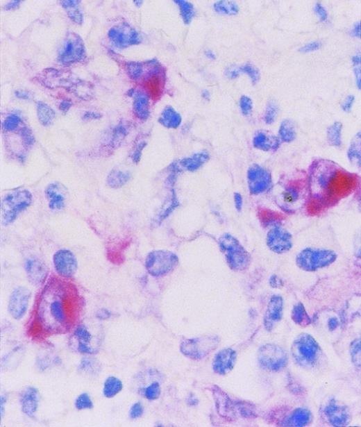 Fig. 2. LMP-1 expression in a case of AIDS-related PCNSL (DLCL). The microphotograph shows that the tumor is polymorphous and predominantly consists of large tumor cells displaying an immunoblastic-plasmacytoid morphology. LMP-1 positivity is evident as cytoplasmic staining in some large tumor cells. Paraffin-embedded tissue section, APAAP immunostaining, hematoxylin counterstain. Original magnification × 630.